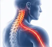 Hernia discal cervical — dolor de cuello a hombro